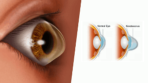 Keratoconus illustration