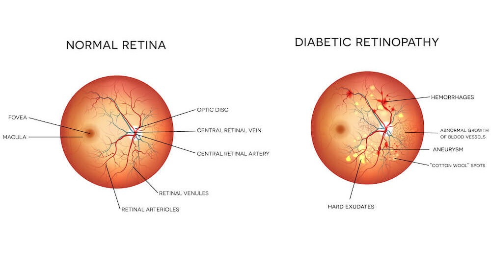 Diagram of diabetic retinopathy