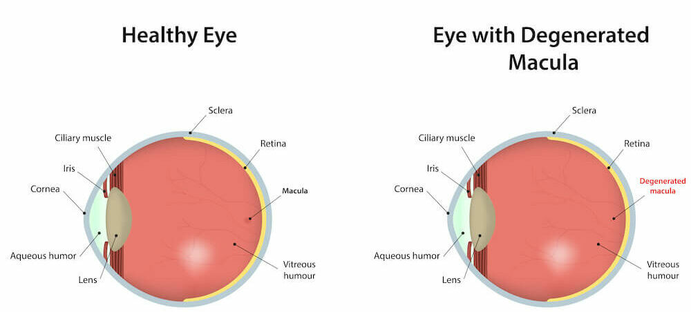 Diagram of macular degeneration