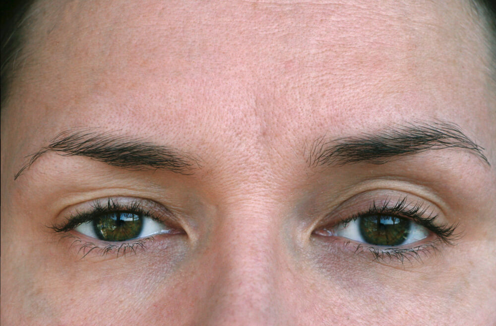 Close up of woman's eyes with ptosis